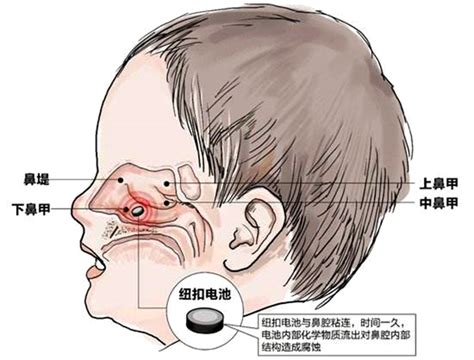 鼻紅|乾貨！「紅鼻子」的常見原因及治療